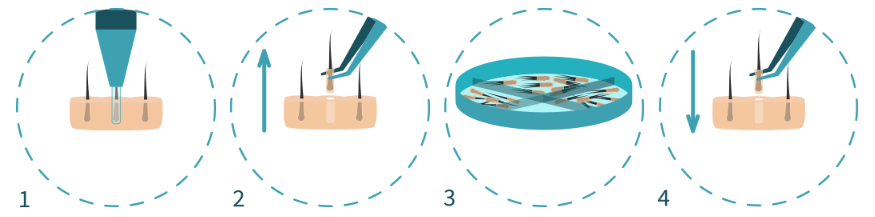 FUE Method Hair Transplant