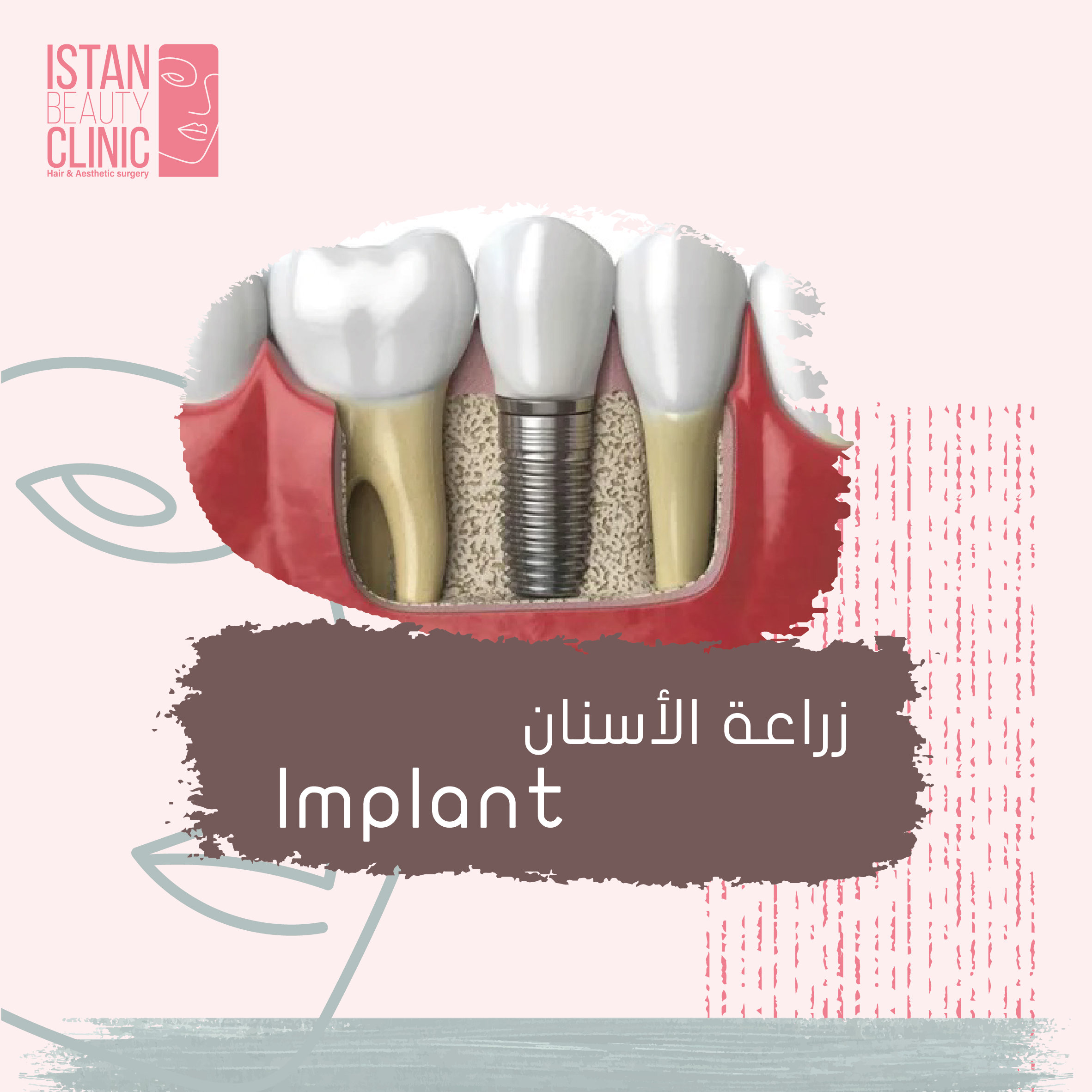Implant