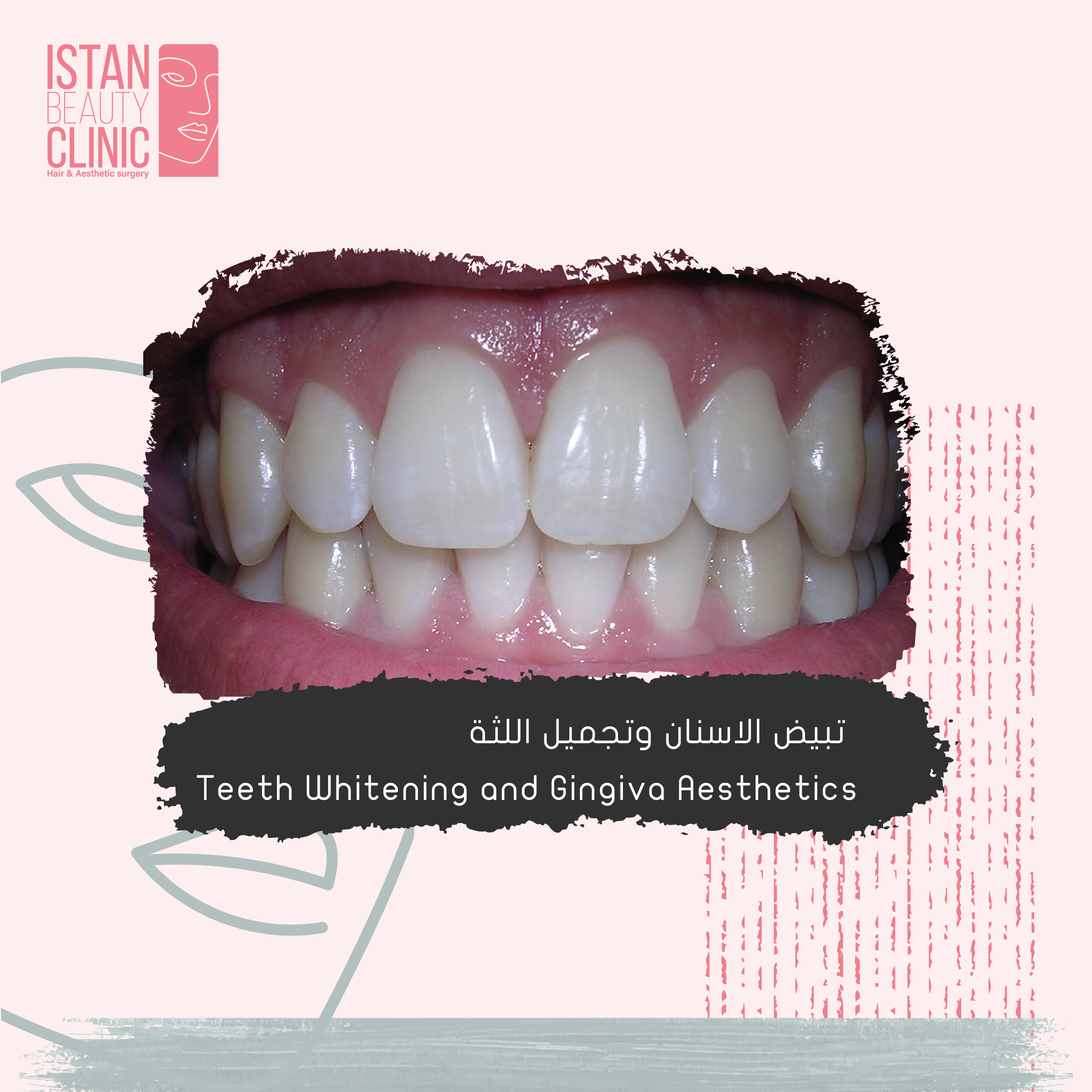 Teeth Whitening(Beaching)