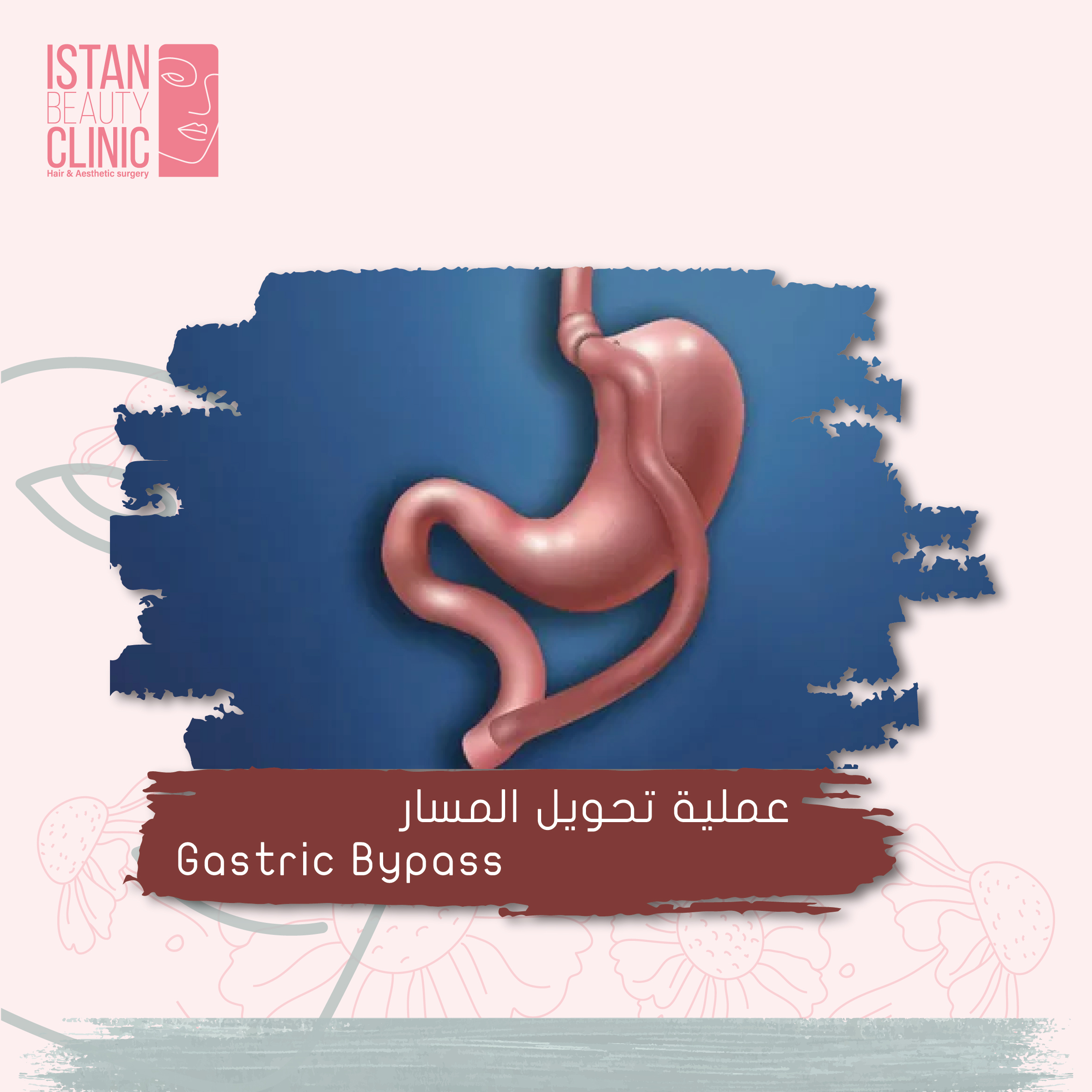 Gastric Bypass