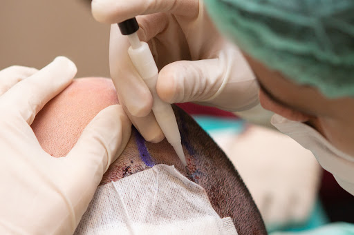 DHI Method Hair Transplant