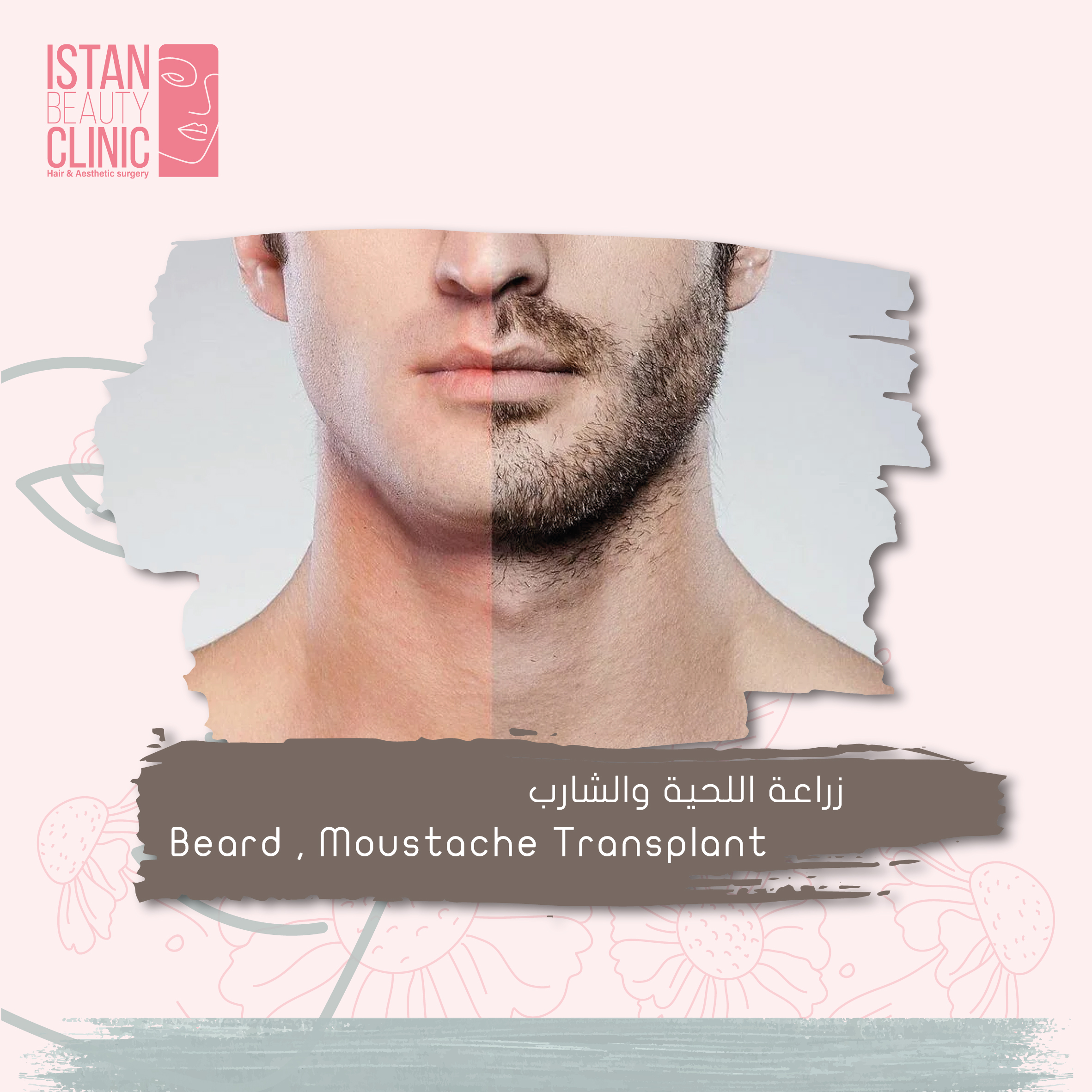 Beard , Moustache Transplant
