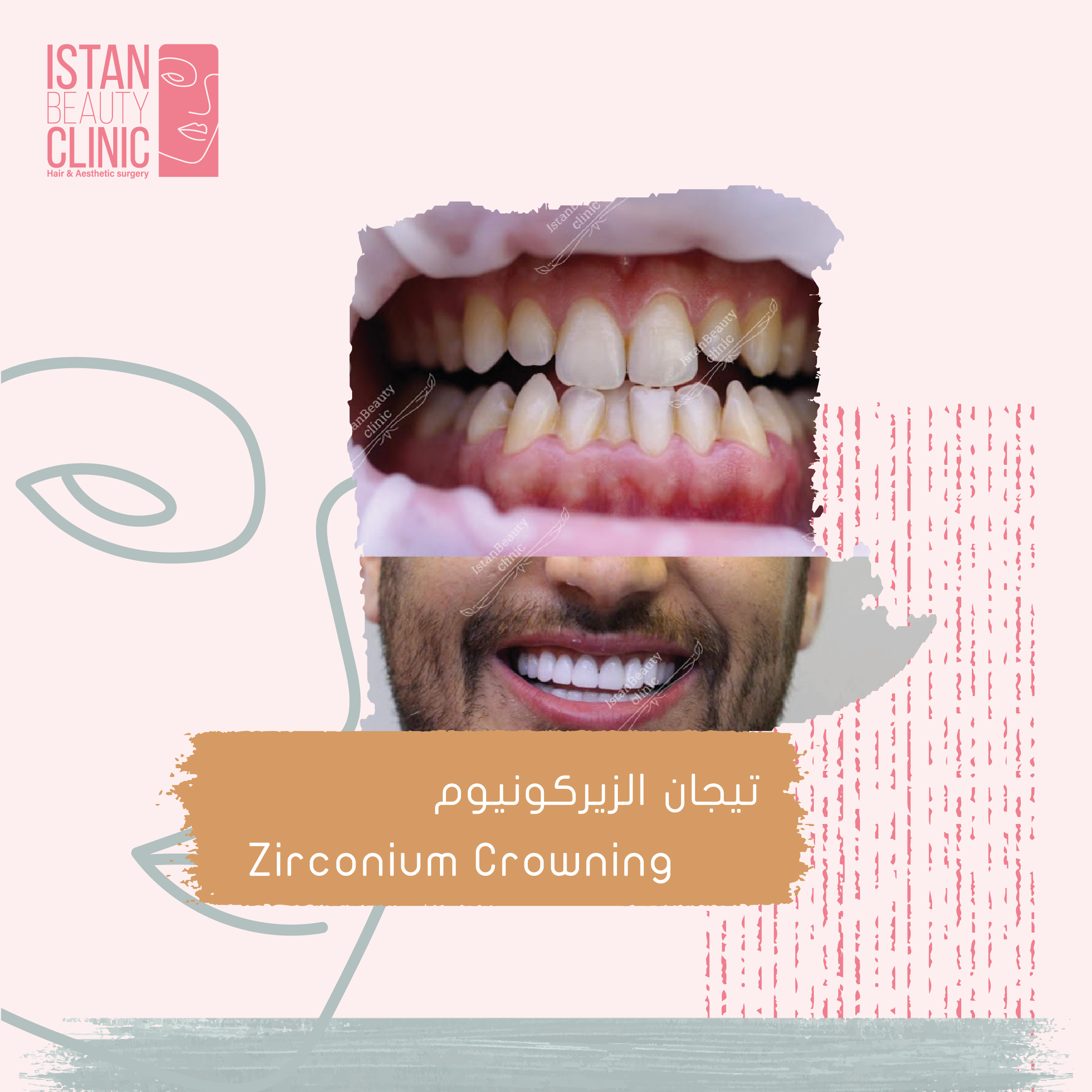 Zirconium Crowning
