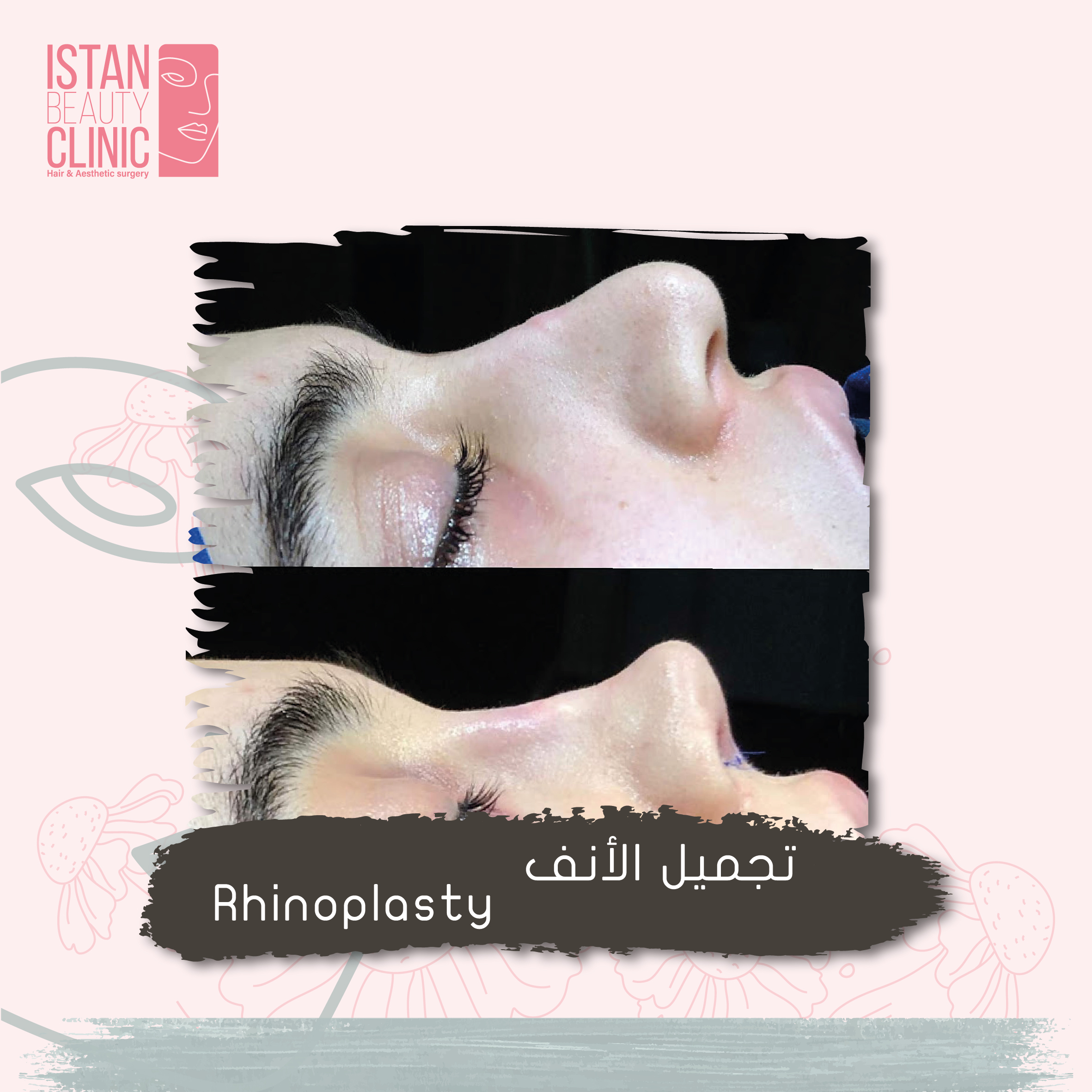 Rhinoplasty
